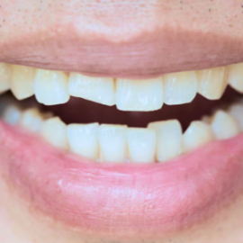 Dente fraturado - Dr. Claudio Santana - LP