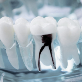 Tratamento de canal - Dr. Claudio Santana - LP