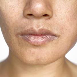 Abscesso facial - Dr. Claudio Santana - LP