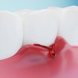 Gengiva inflamada - Dr. Claudio Santana - LP