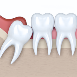 Siso inflamado - Dr. Claudio Santana - LP